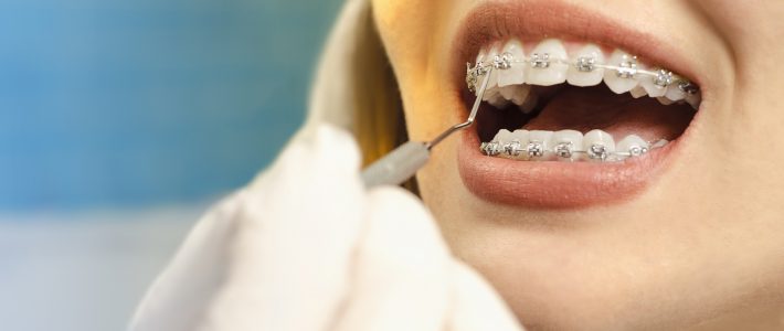 Aparat ortodontyczny – informacje